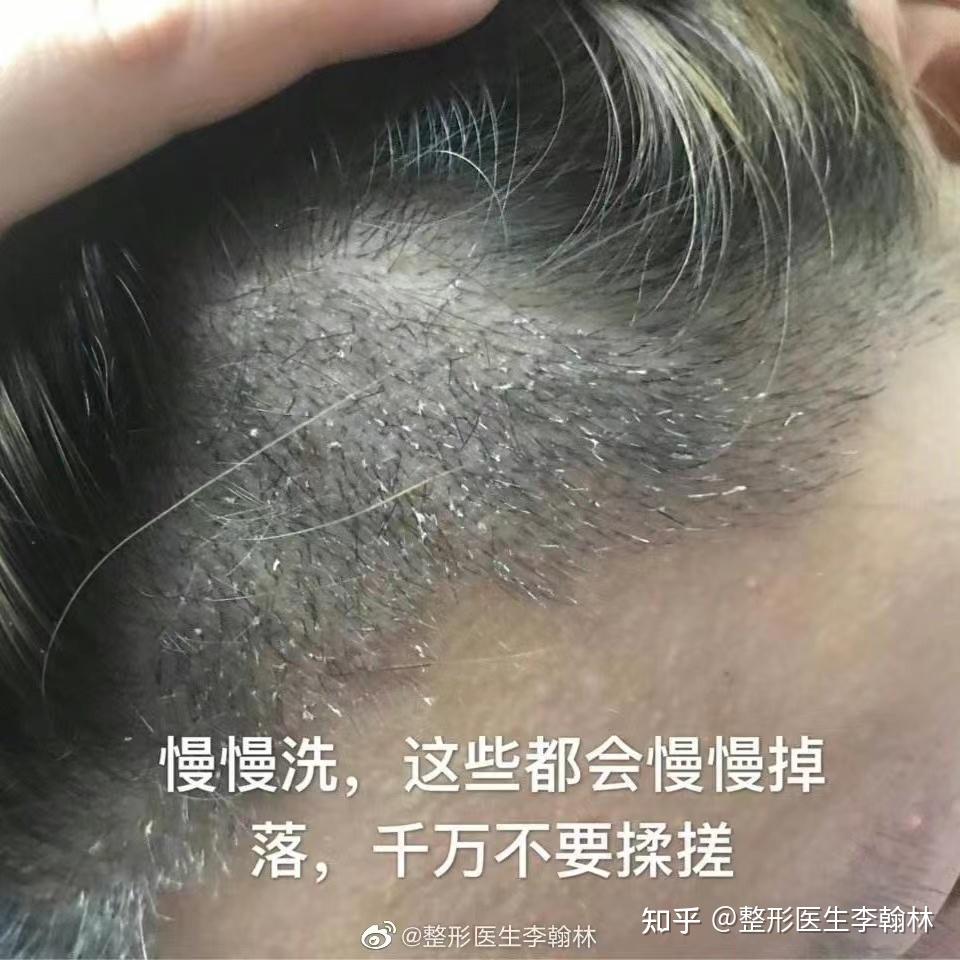 植发后多久清理血痂比较好呢? - 知乎