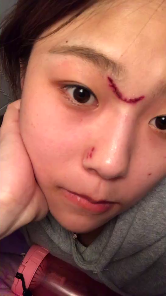 女生脸上有疤是怎样的体验?