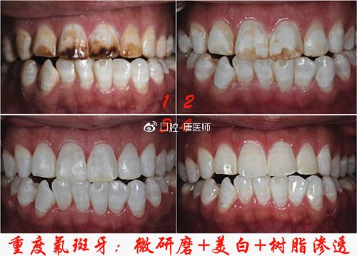 第三种 内源性黄牙