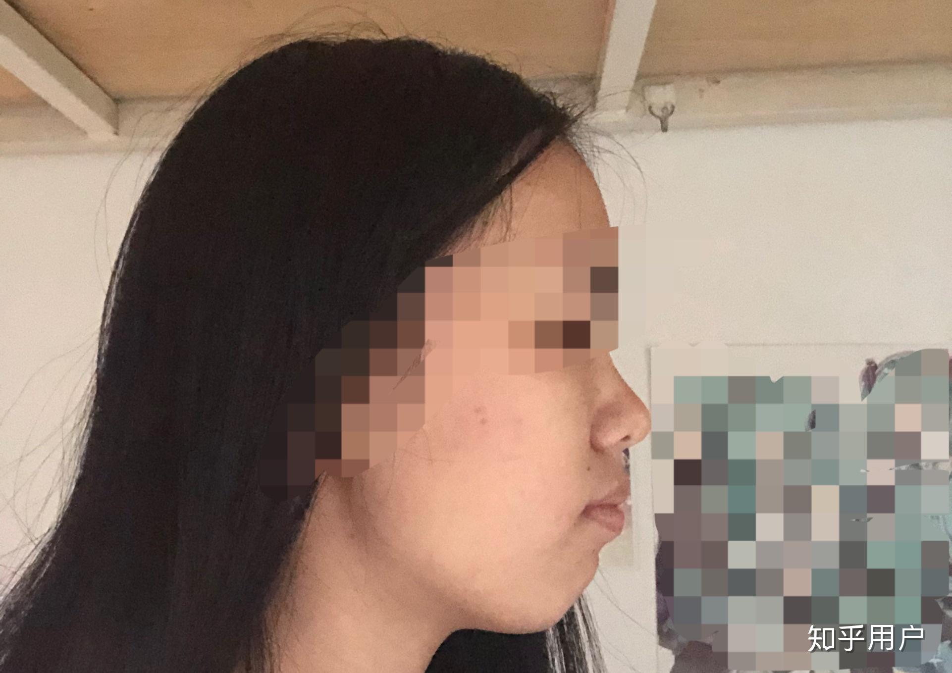 口呼吸面容成年后可以矫正吗? - 知乎