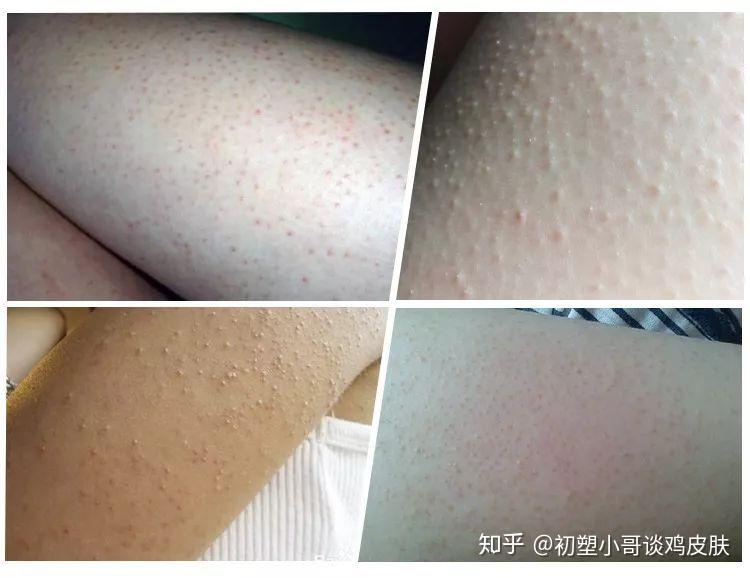 去除鸡皮肤的妙招(去除鸡皮肤的妙招图片)