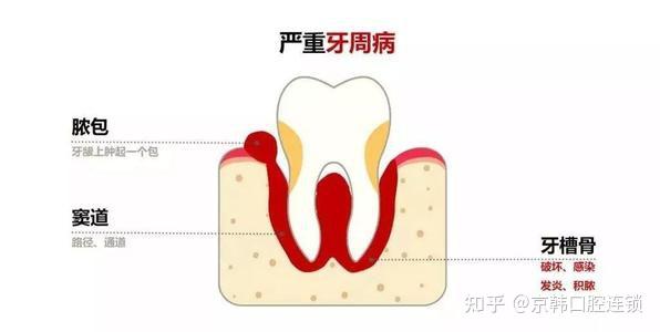 牙齦上出現膿包是怎麼回事