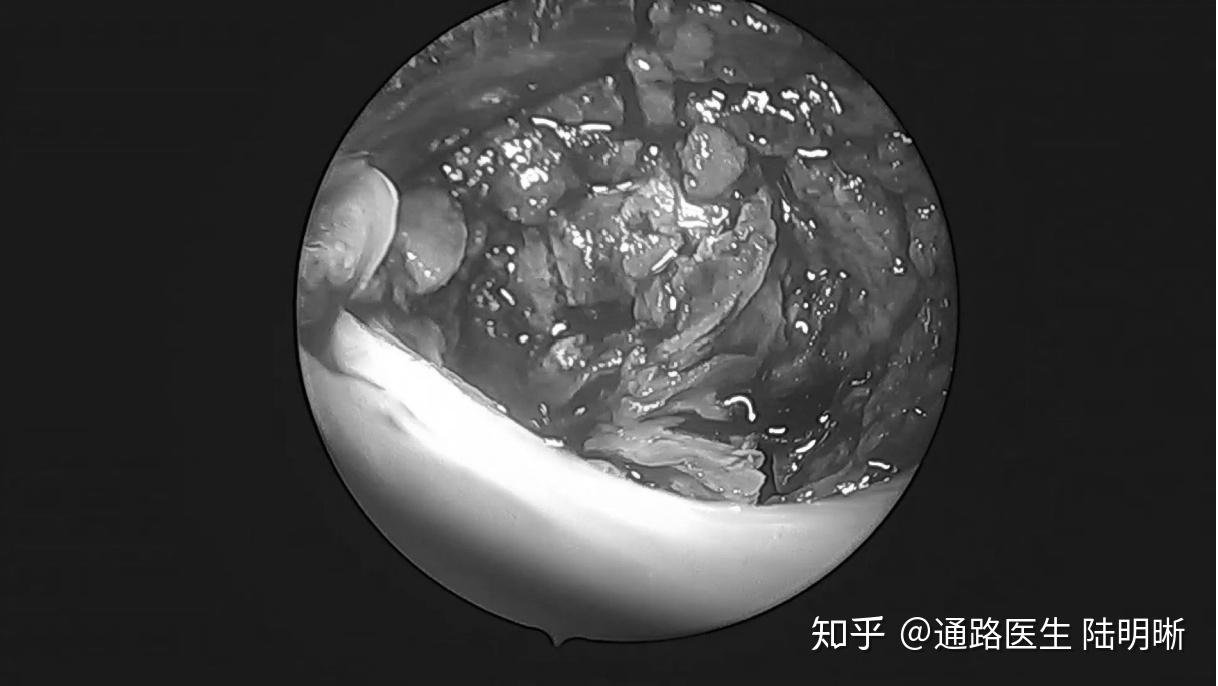 腔镜辅助下内瘘机化血栓切除术 