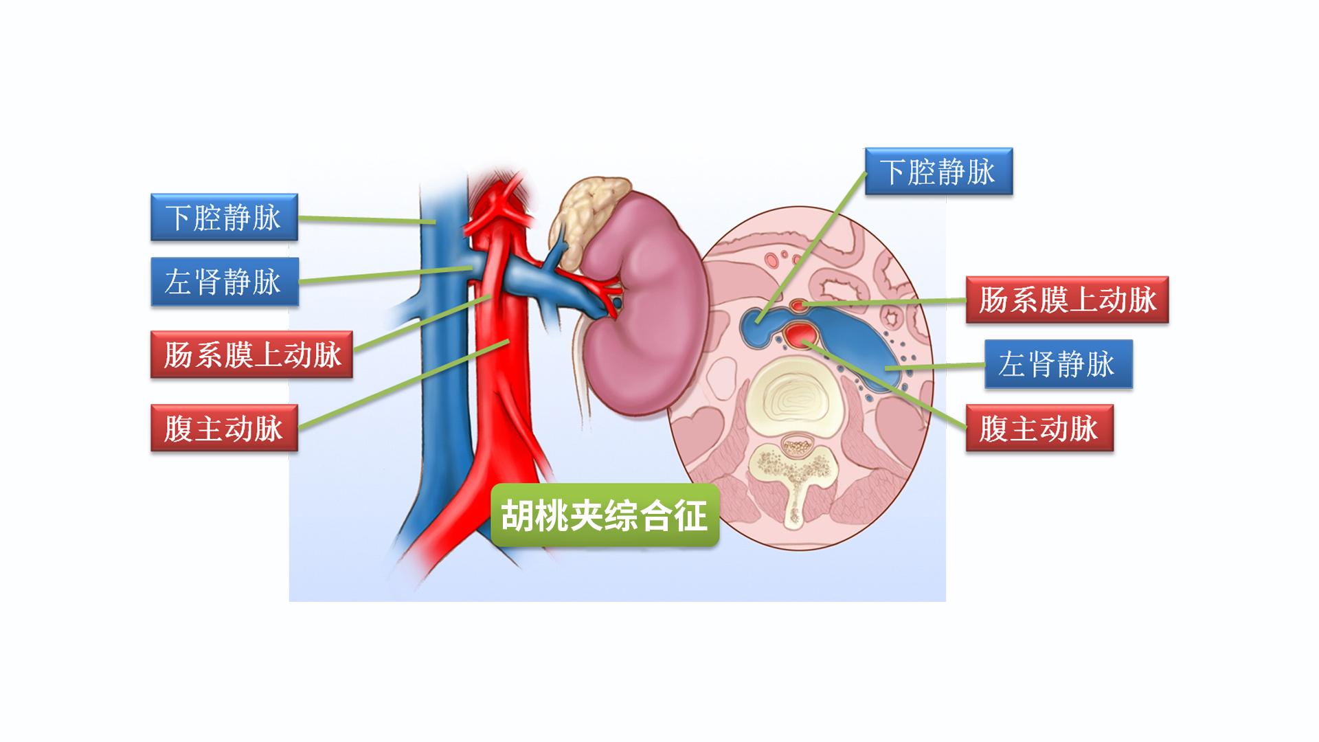 我们可以想象,肾静脉回流有阻碍的时候,左侧的精索性腺静脉回流也会