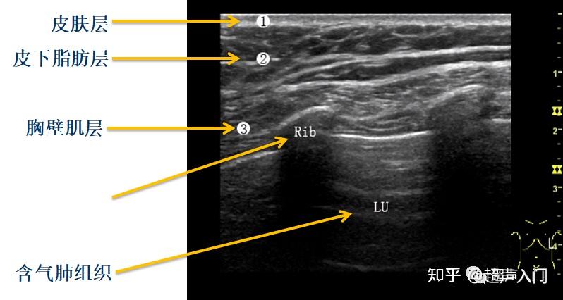胸水的超声测量图解ppt图片