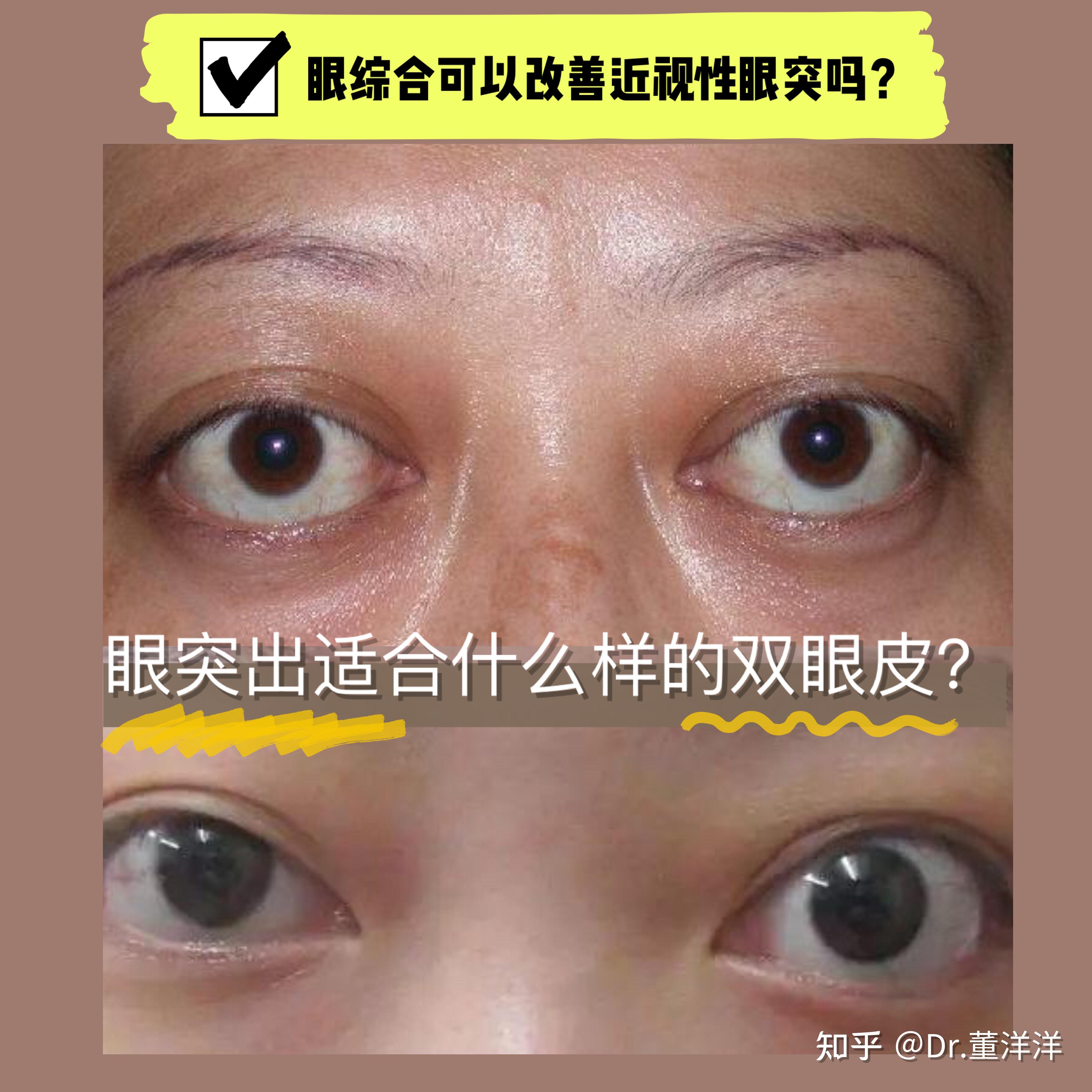 眼综合可以解决近视性的眼突吗
