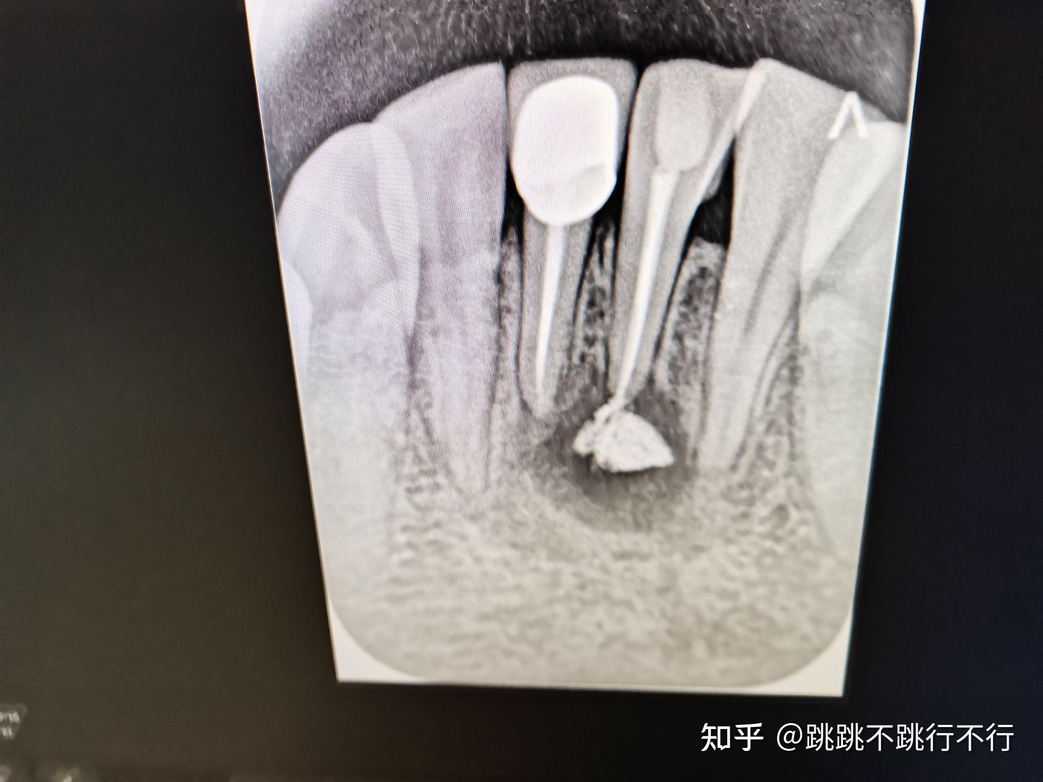 根尖手術 - 高雄根管治療專家-牙髓病專科王俊欽牙醫師