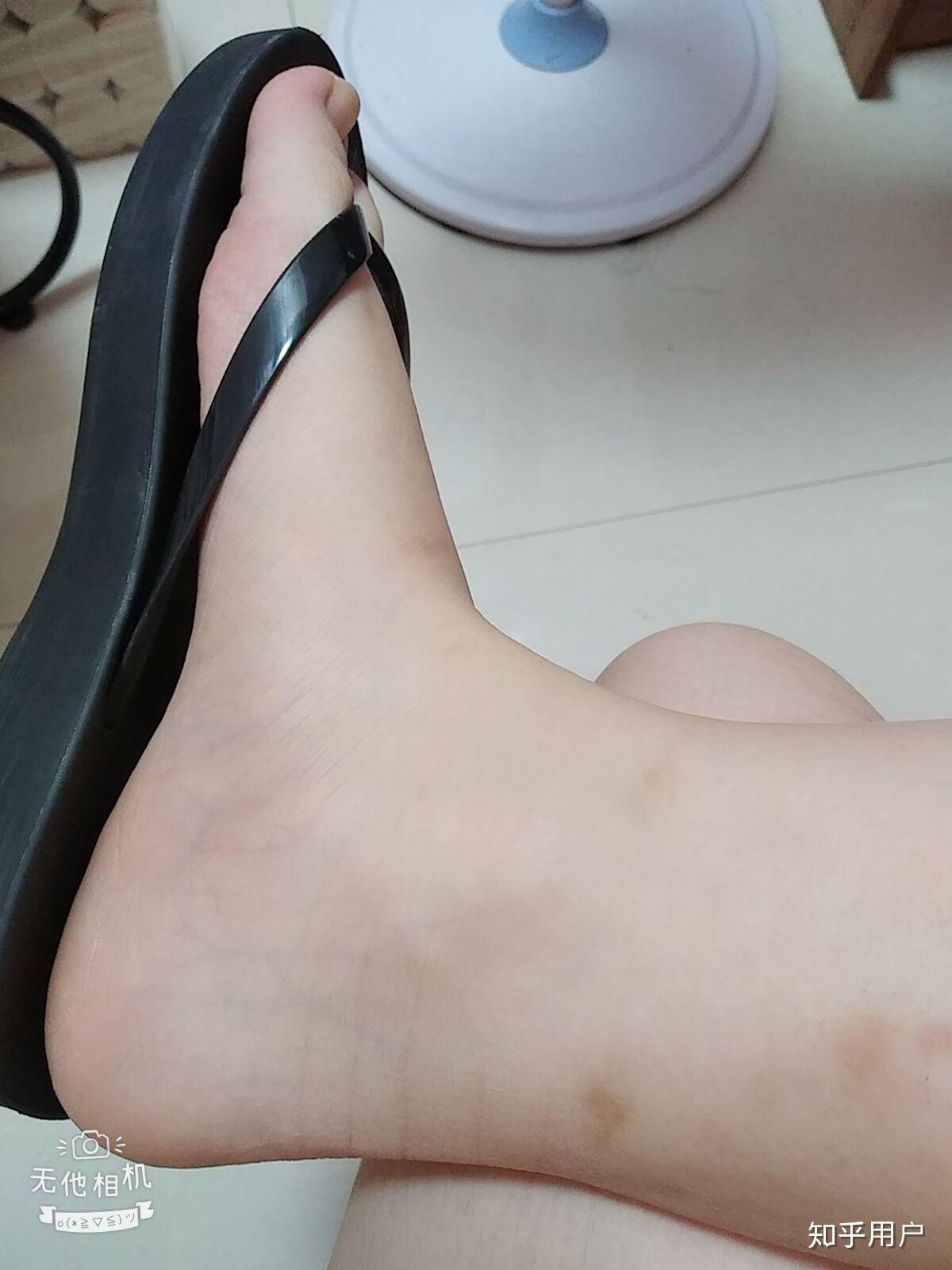 女生脚踝粗是基因决定的吗