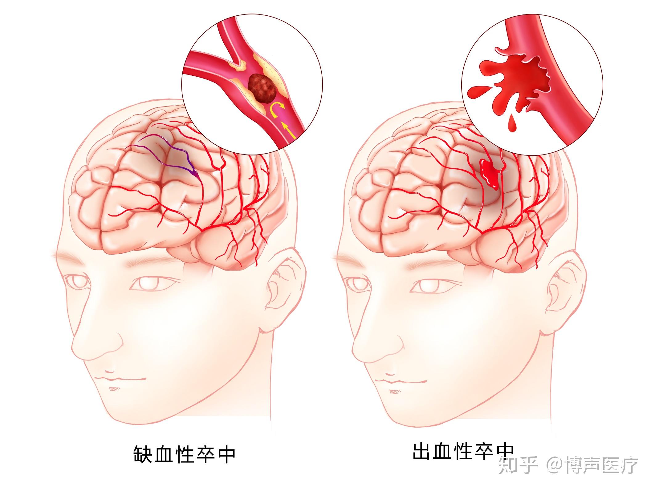 脑梗是什么病图片