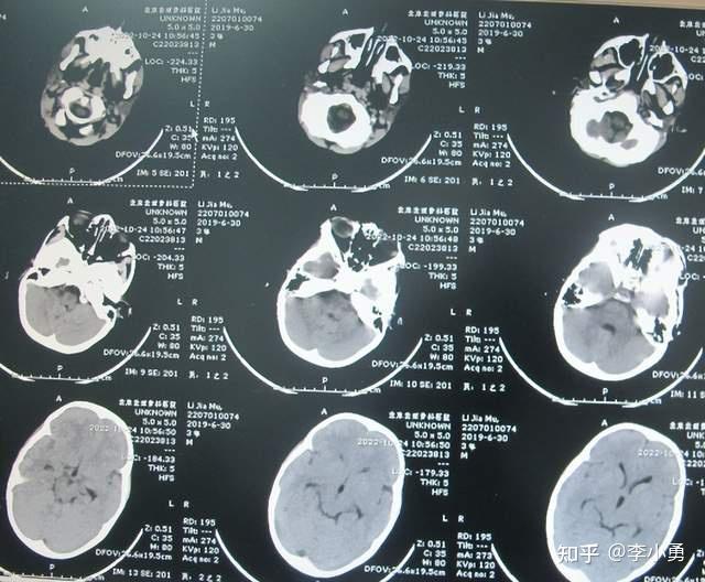 一,李小勇脑脊液科入院前病史患儿有先天性脊髓栓系,出生后无明显不适