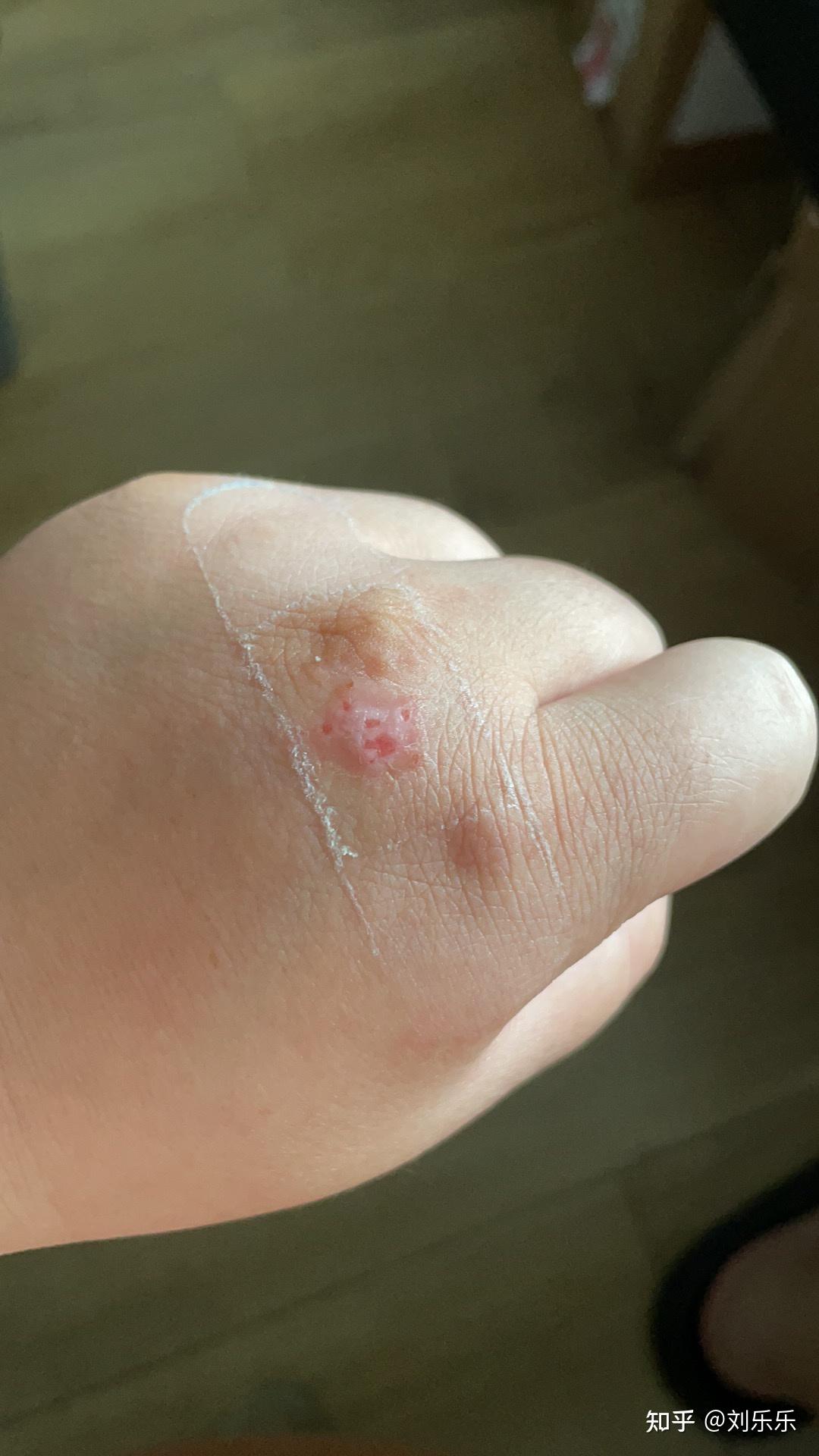 14还没发的时候,第二张图是结痂快好的时候同时,右手中指和无名指第