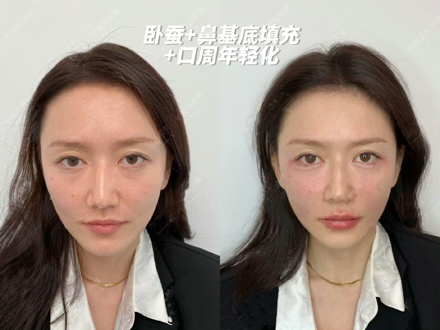 两道法令纹跟刀劈似的,巨深、到底什么方法才能真正有效的改善法令纹? - 知乎