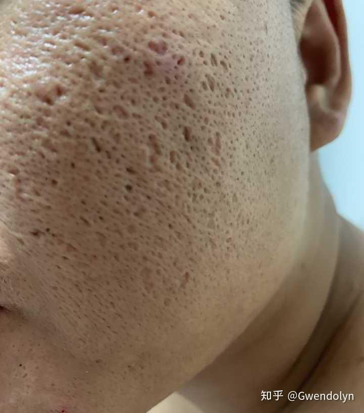 如果你是下面这种毛孔(坑),请出门打车直接去医美!