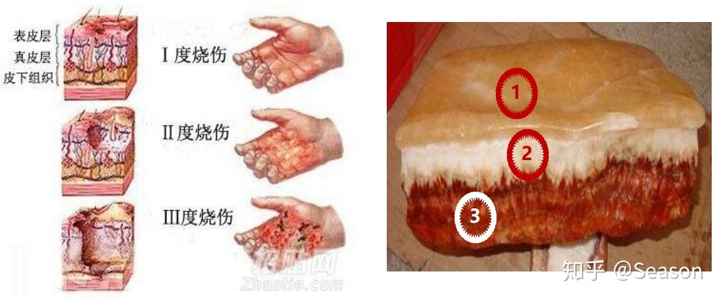 重疾理赔解释19——严重Ⅲ度烧伤