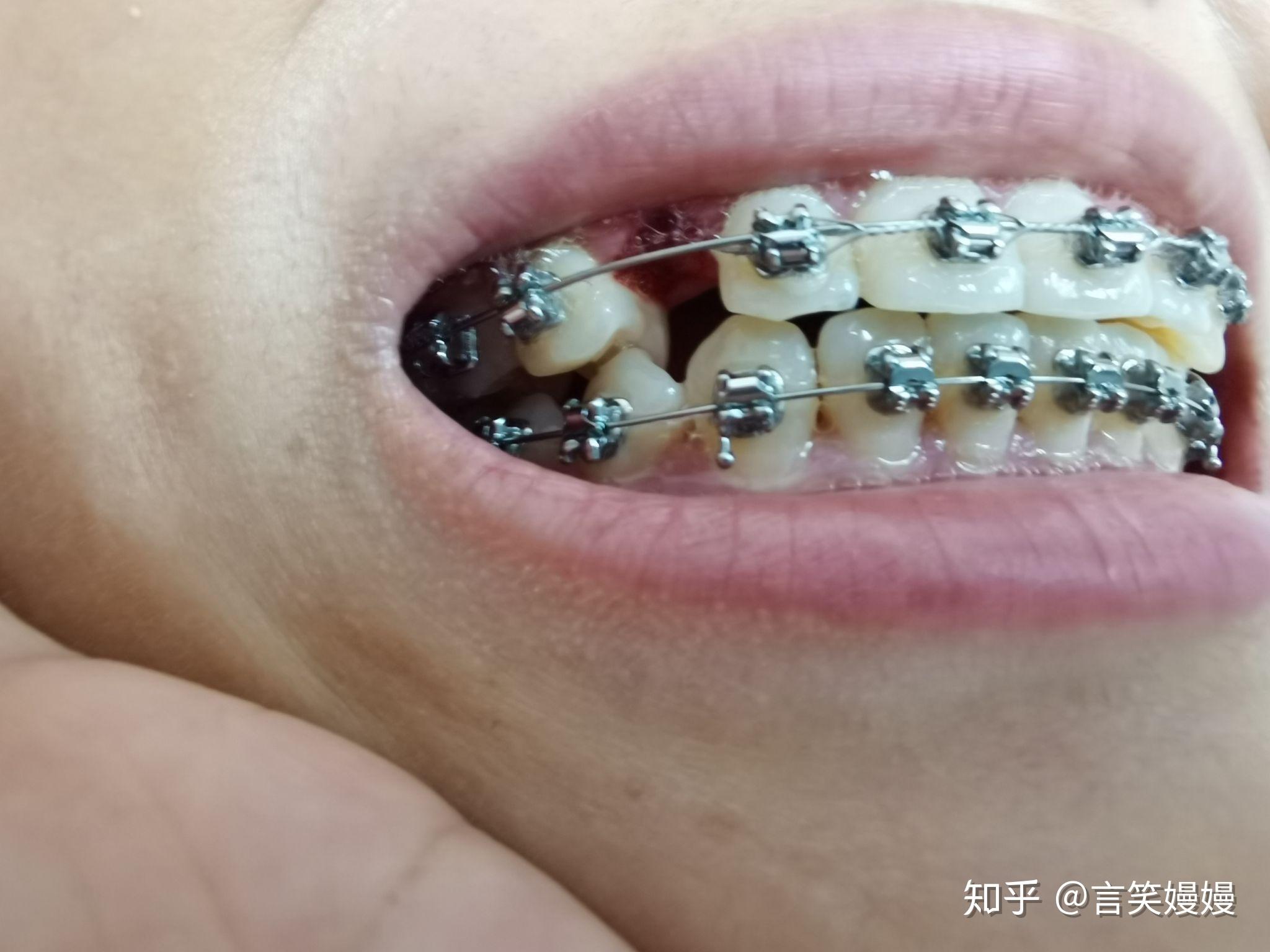 了酸爽的感觉,乳牙还未拔,感觉侧脸有了一点的变化,也有一点牙套脸了