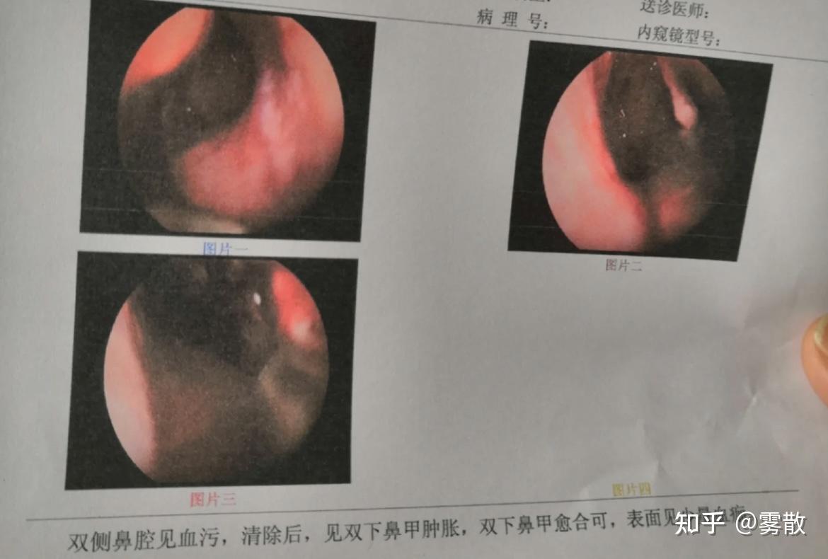 怎樣治療鼻竇炎鼻竇炎頭疼怎麼緩解