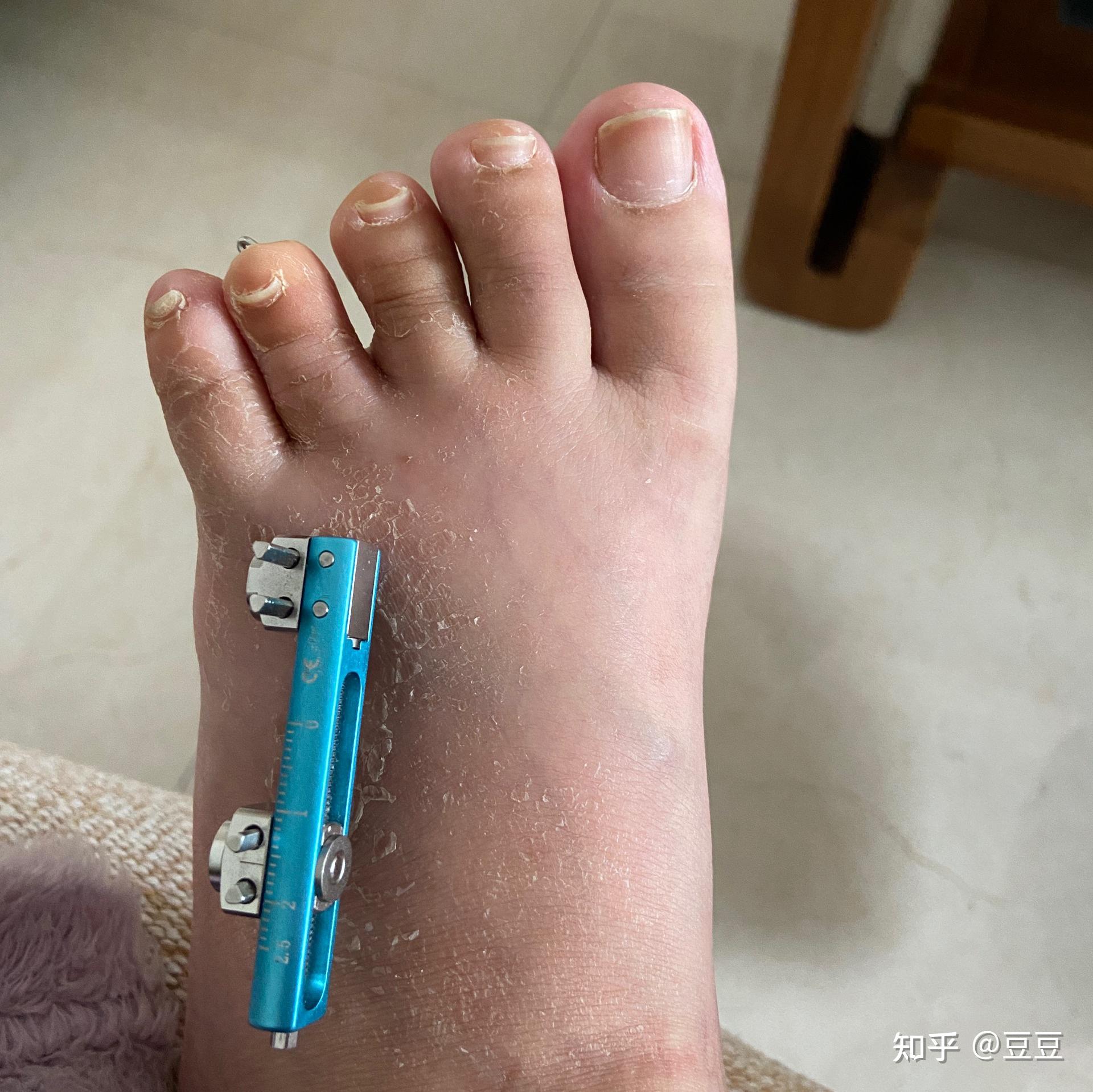第四脚趾短小症手术有没有风险?