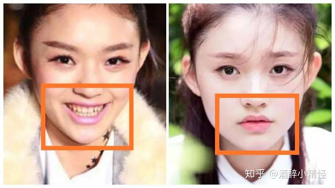 林允的烤瓷牙为什么不好看整牙真的会变牙套脸吗