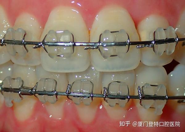 还有一种半隐形牙套可以选择,就是陶瓷托槽的牙套.