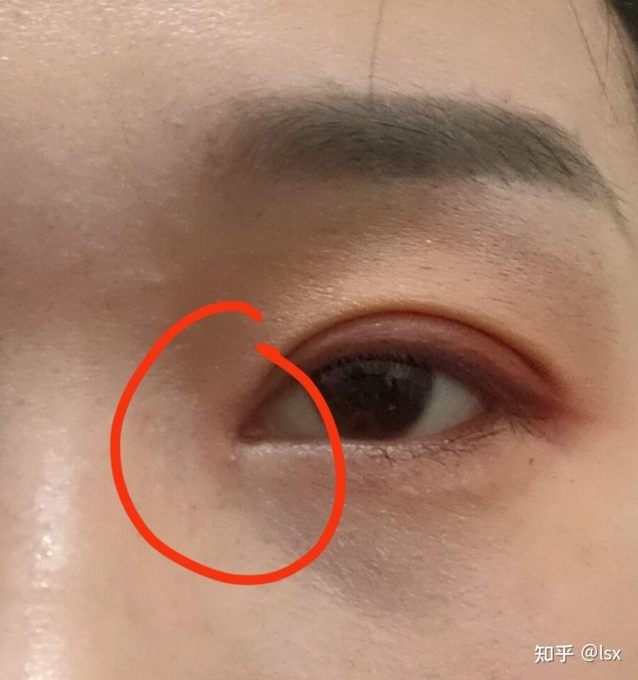 开眼角后有白色小颗粒状是怎么回事?