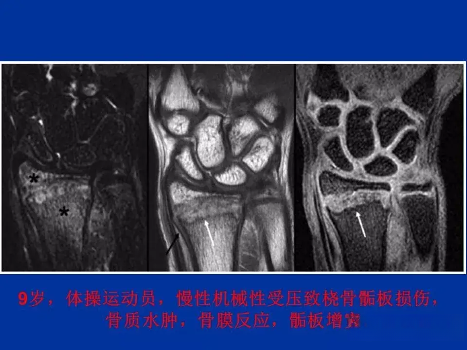 骨骺软骨损伤MR高清影像诊断图文详解 - 知乎