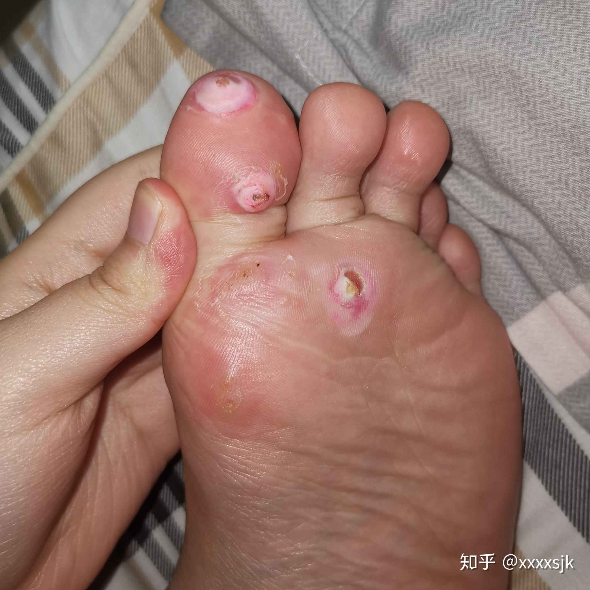 治鸡眼记录 - 知乎