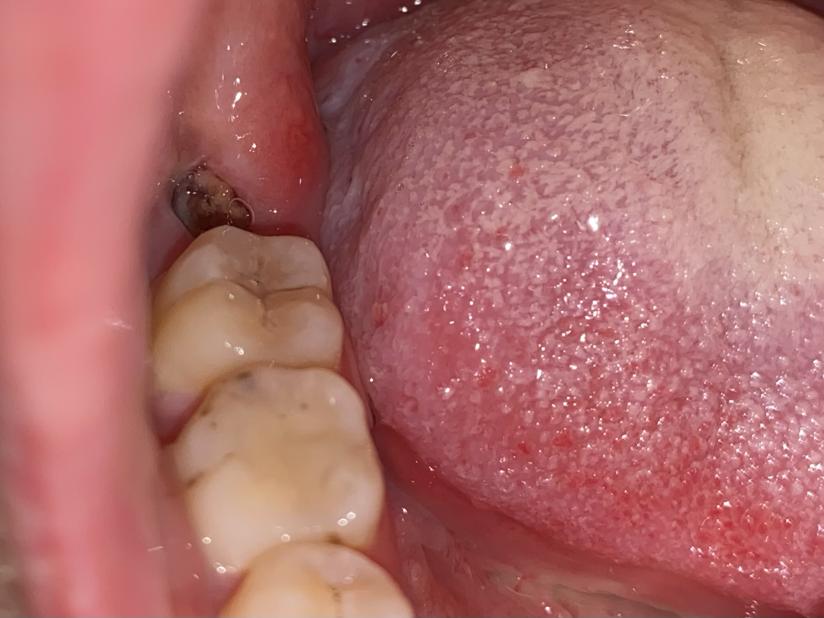 拔牙7天后牙窝状态图图片