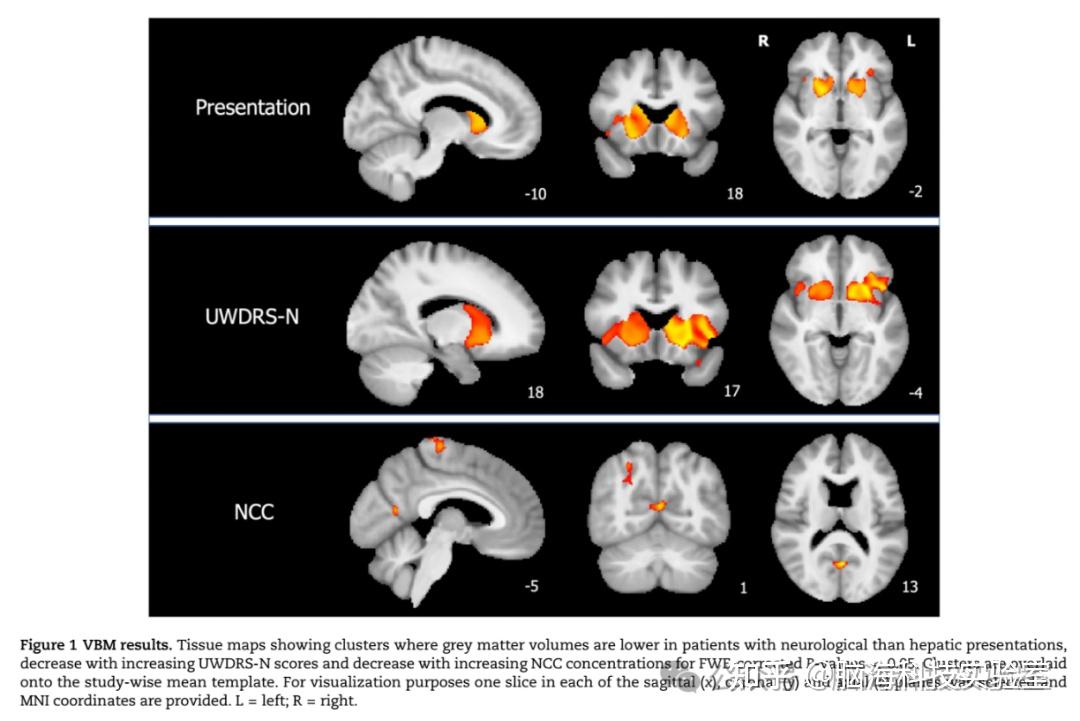 Brain:威尔逊病脑损伤的神经影像学相关因素:一项多模态全脑磁共振成像研究 - 知乎