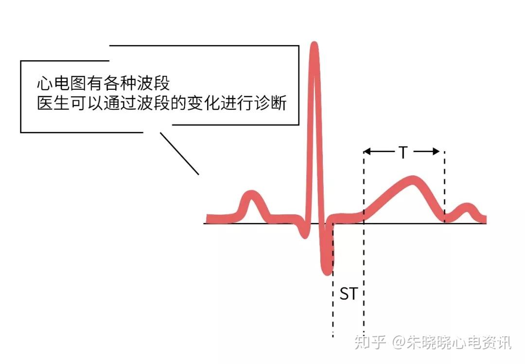 心脏不难受为什么还要去查心电图心电图不是你想象的那么简单