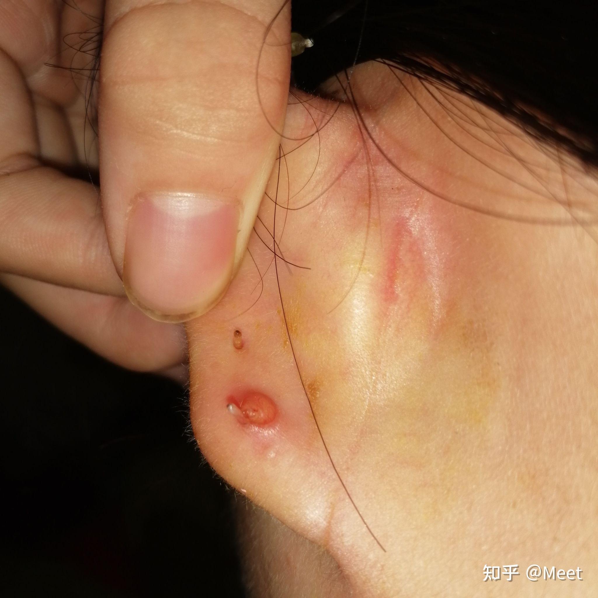 耳洞发炎的look me