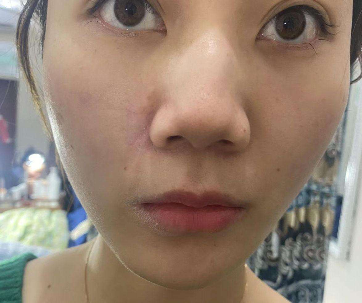 女生脸上有疤是怎样的体验？ - 知乎