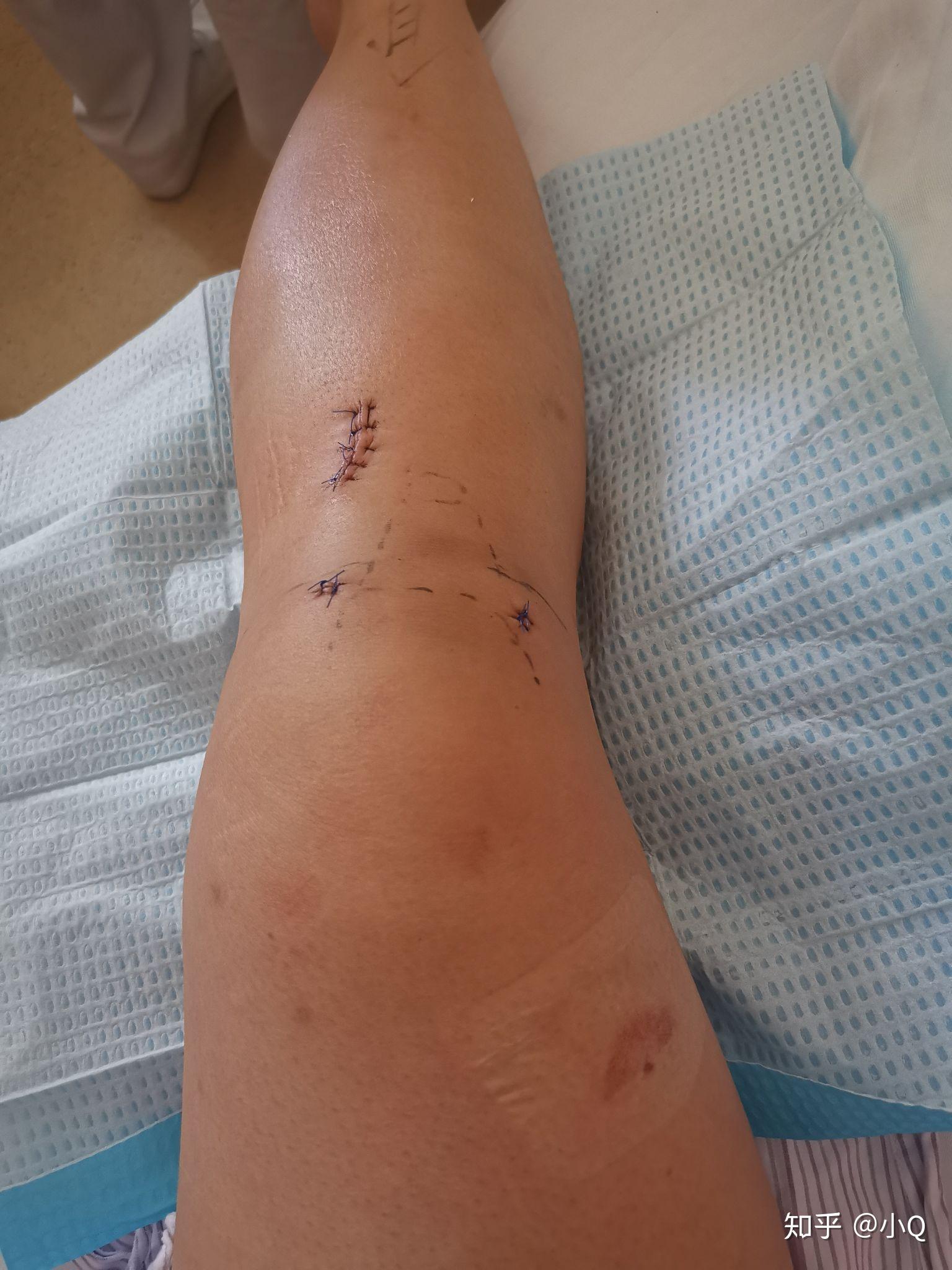 坐标深圳,也来说说我的前交叉韧带重建,半月板内侧两针修补及康复之路