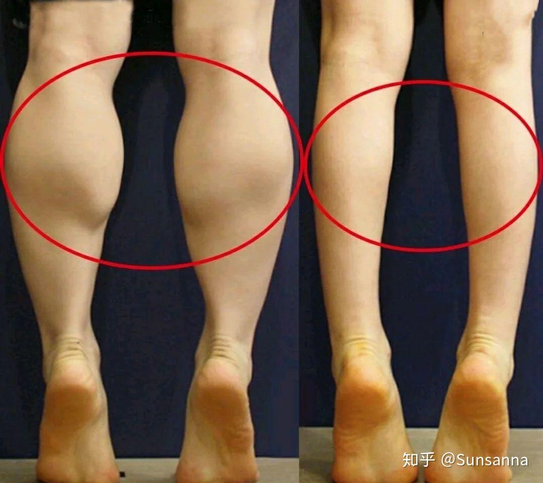 这种腿能瘦吗