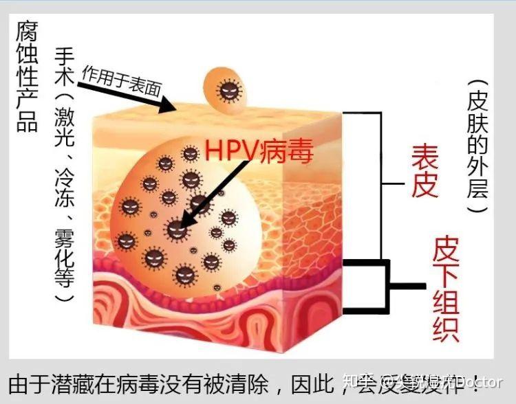 尖锐湿疣复发的原因