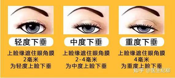 眼露三白是什么状态?深度解析被名字耽误的“死鱼眼” - 知乎