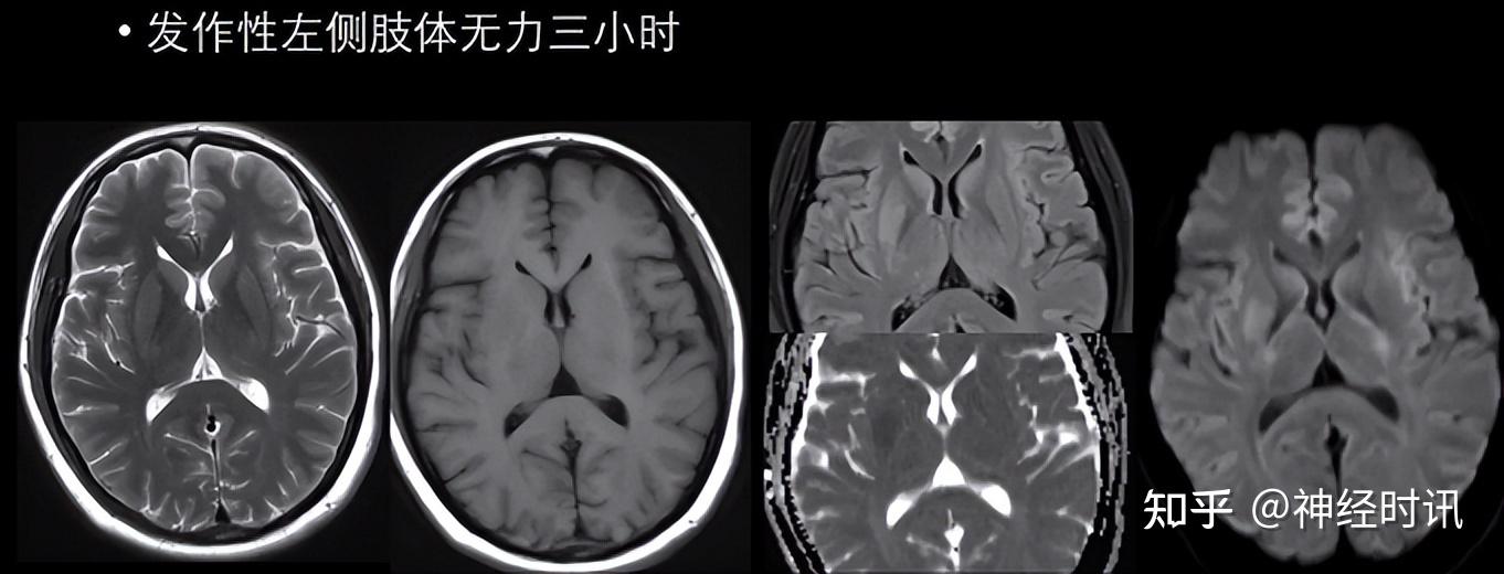 脑磁共振图片