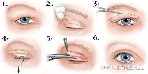 内双适合做双眼皮么? - 知乎