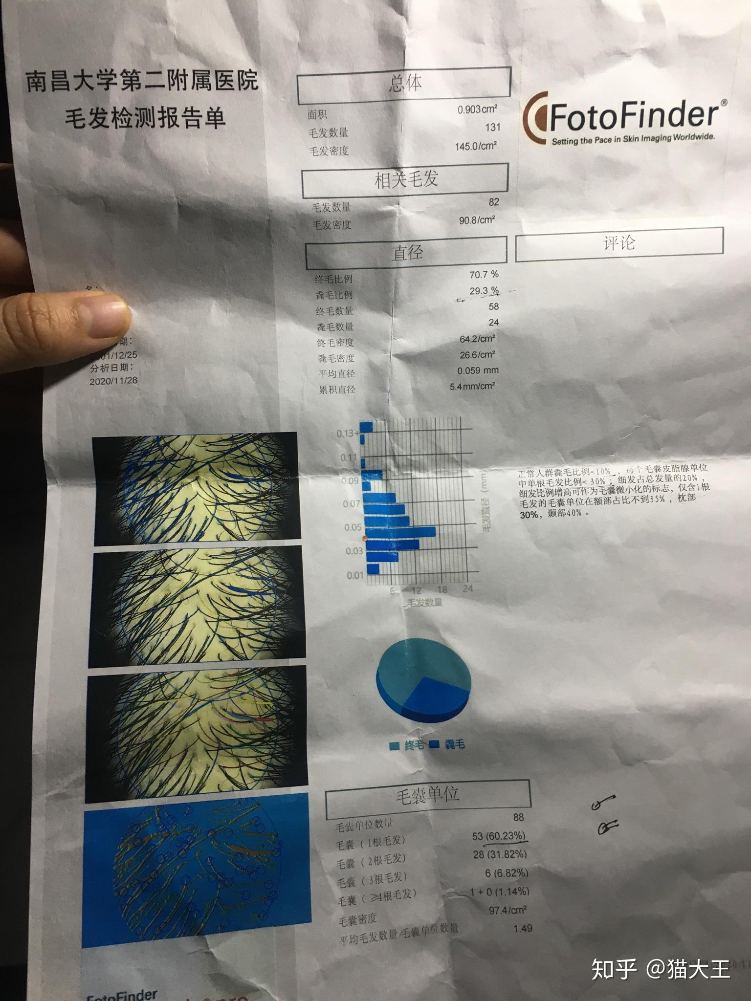 今天就去医院,咨询了医生,并且做了个毛囊检测,我们这做一次130元左右