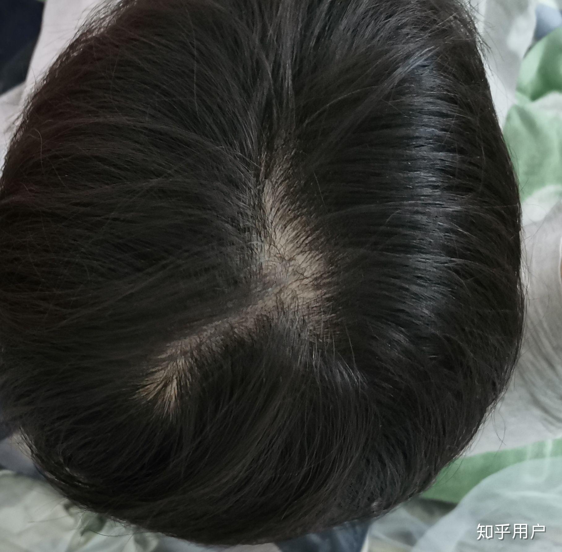 女生头顶头发少是什么体验