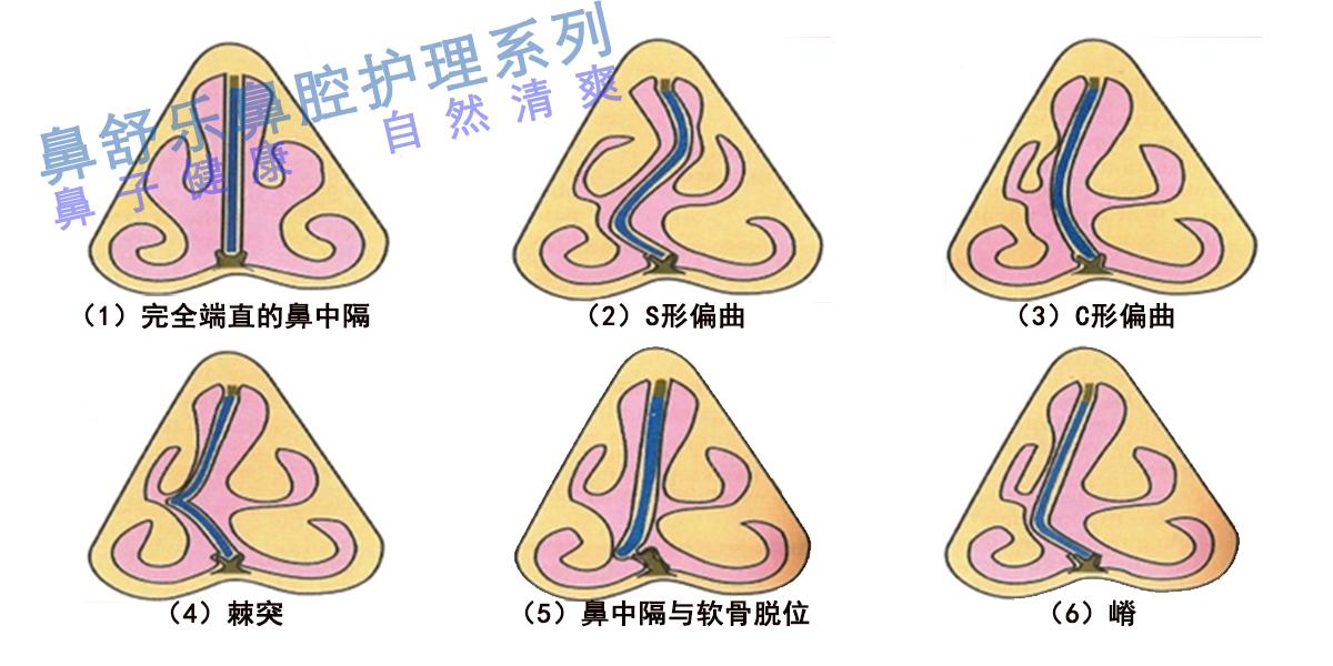 怎样缓解鼻炎鼻塞? - 知乎