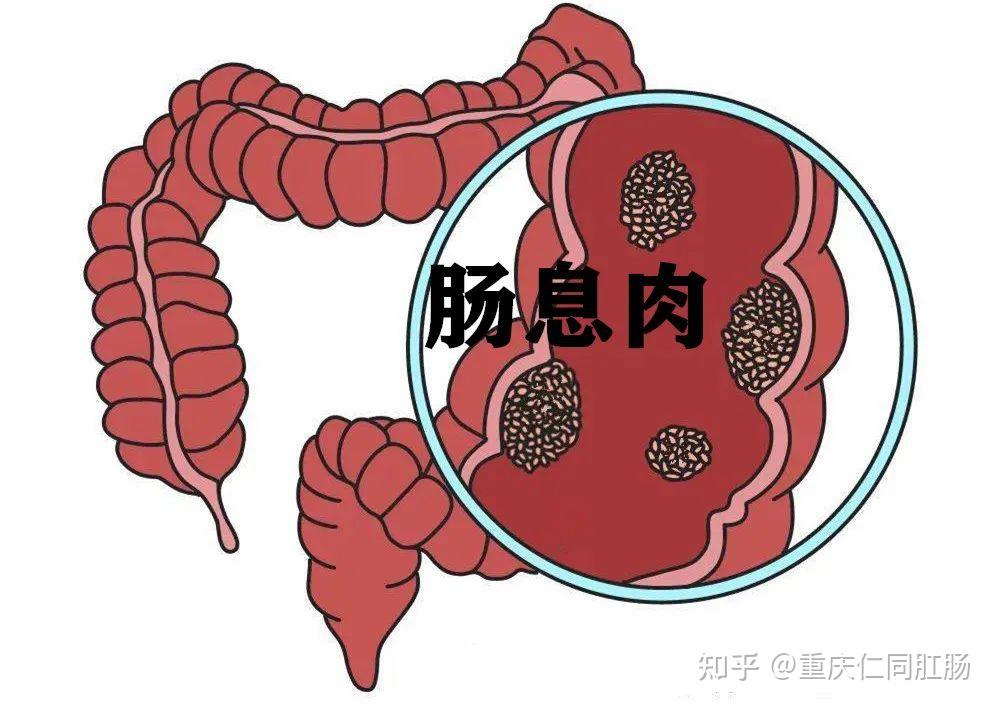 肠息肉卡通图片
