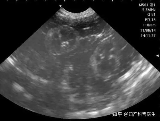 彩超?B超?阴超?到底都是些啥,我应该怎么选? - 知乎