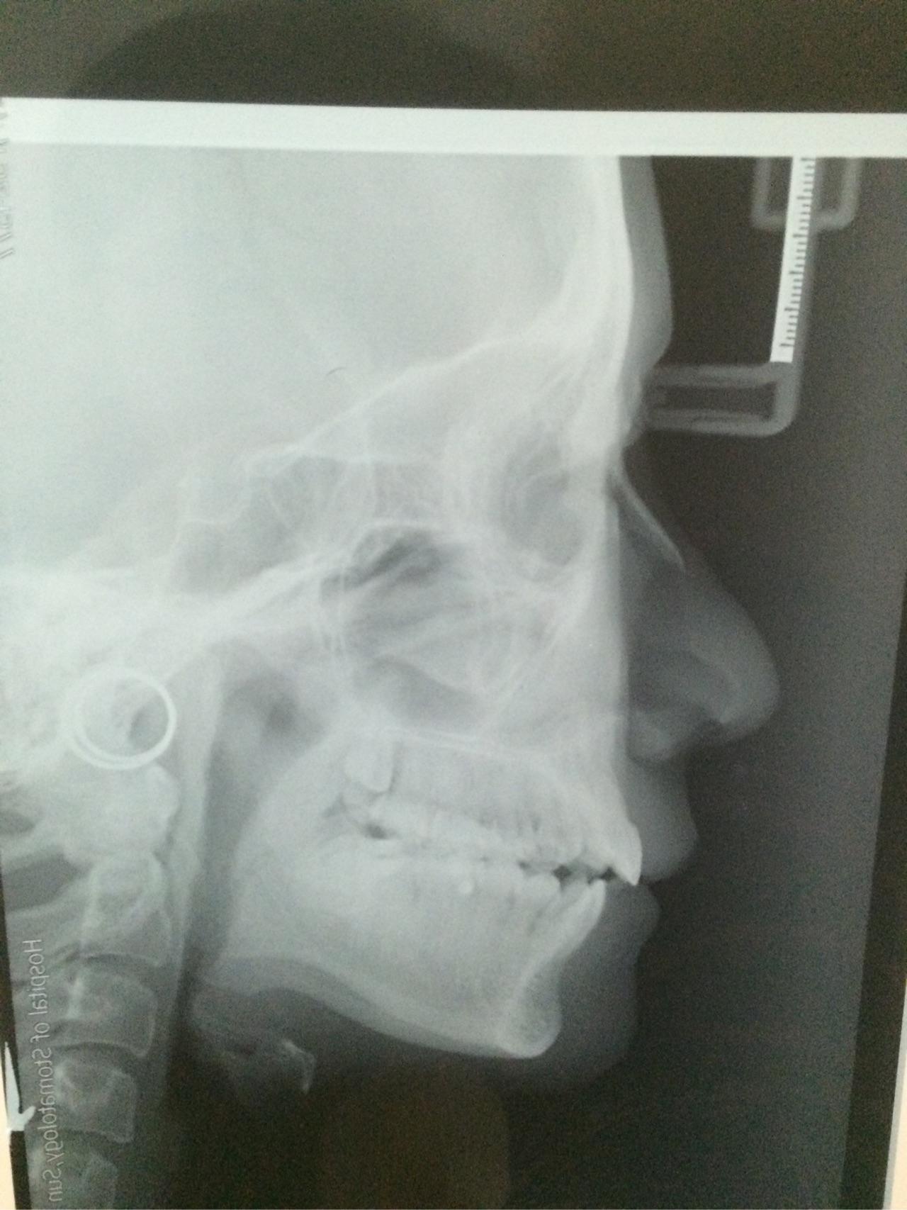 22岁.开始绝望的二次矫正了。如何选择医院和