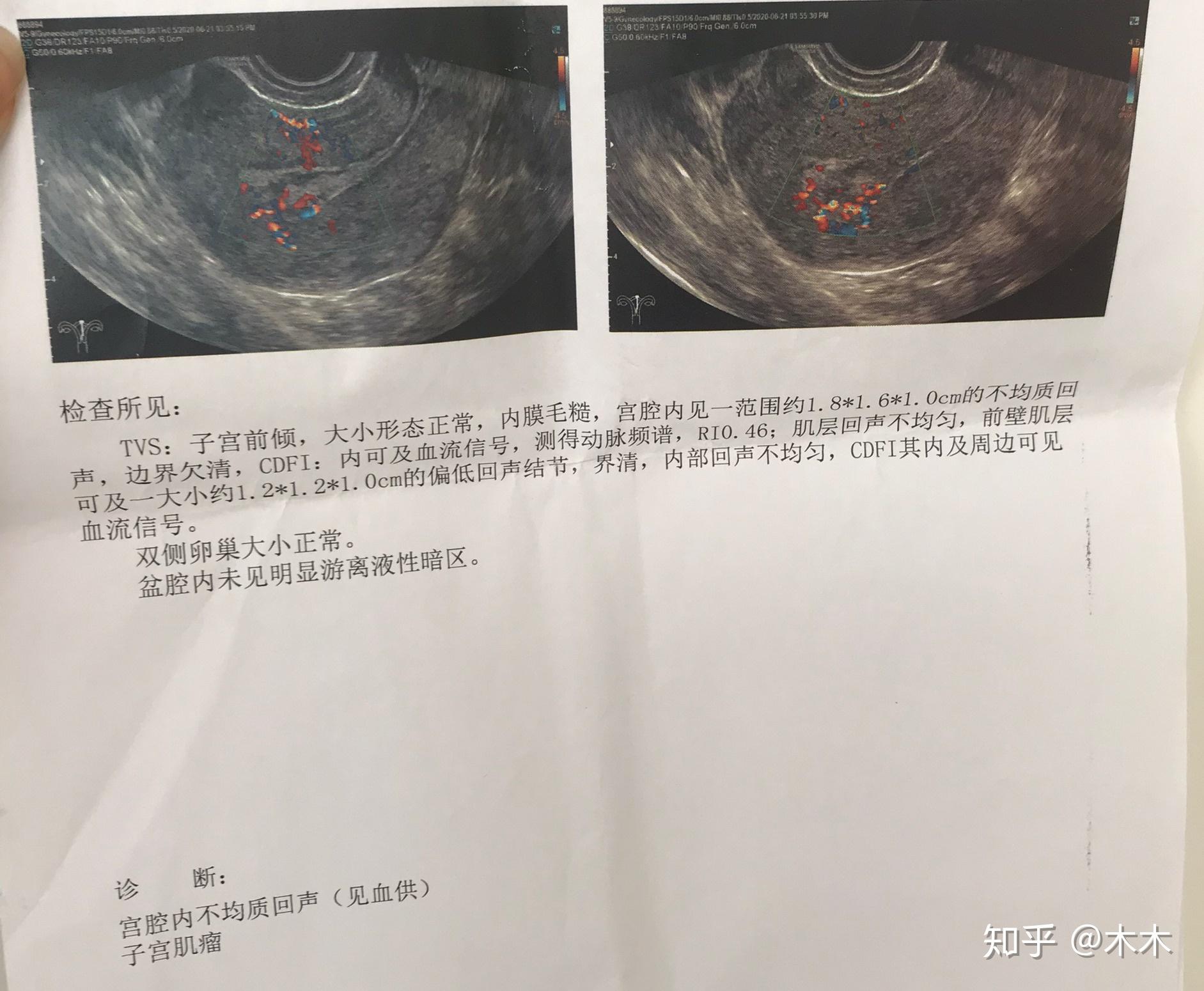 记录我的2次药流经历