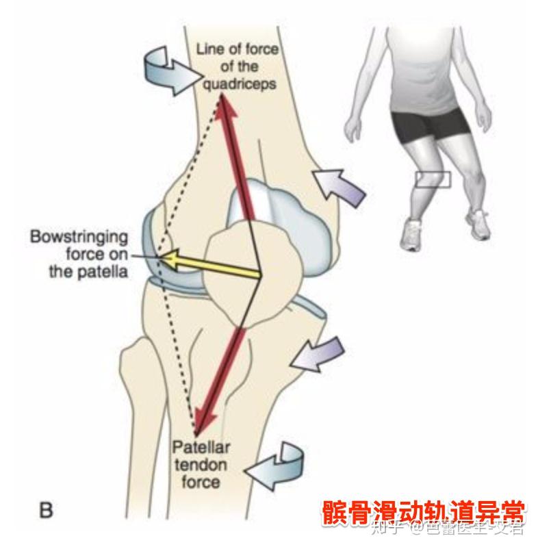 损伤:髌骨滑动轨迹偏离正常轨迹,会撞击到股骨髁引起疼痛,时间长了会