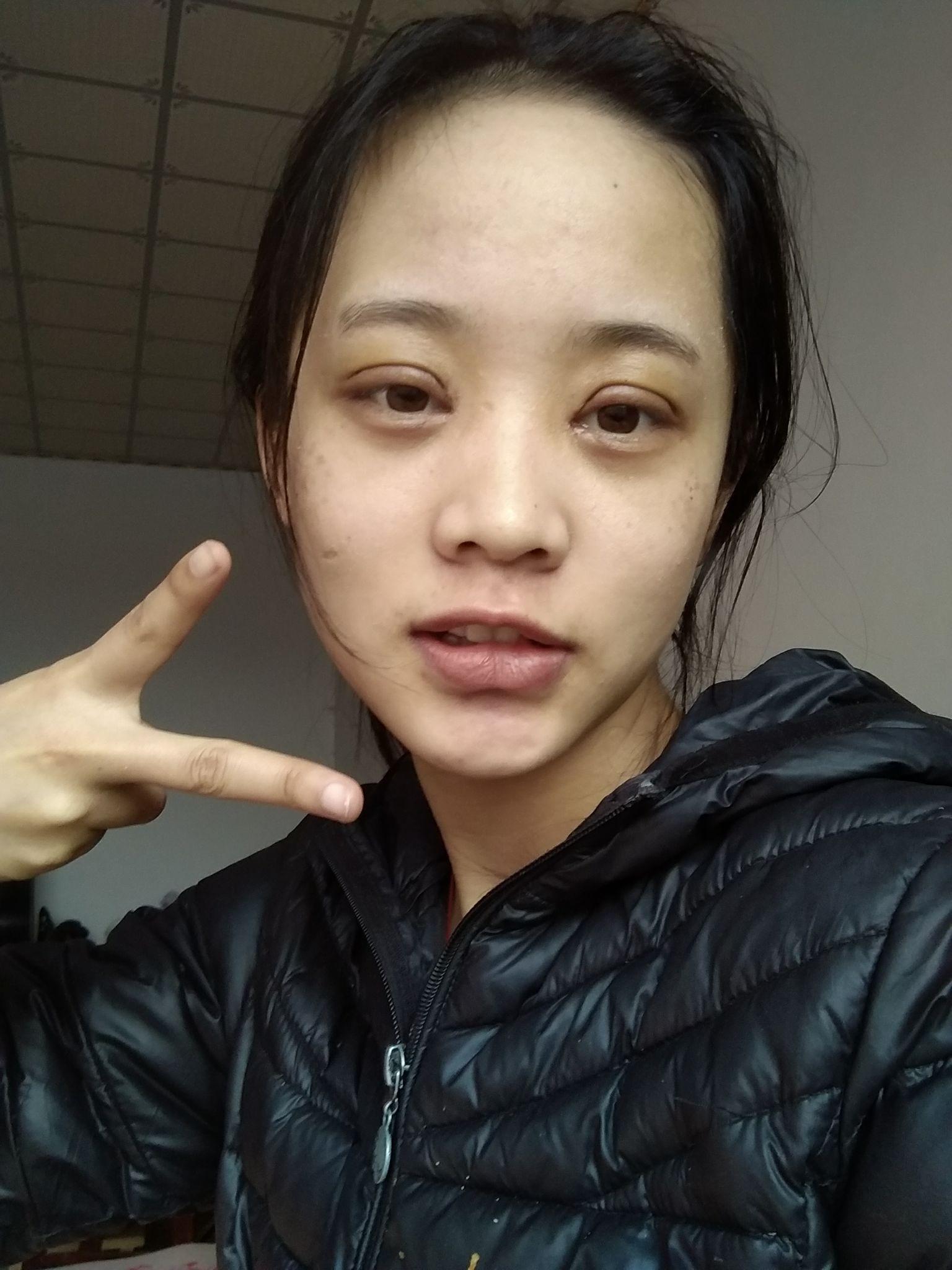 双眼皮 全切6mm&开眼角 - 知乎