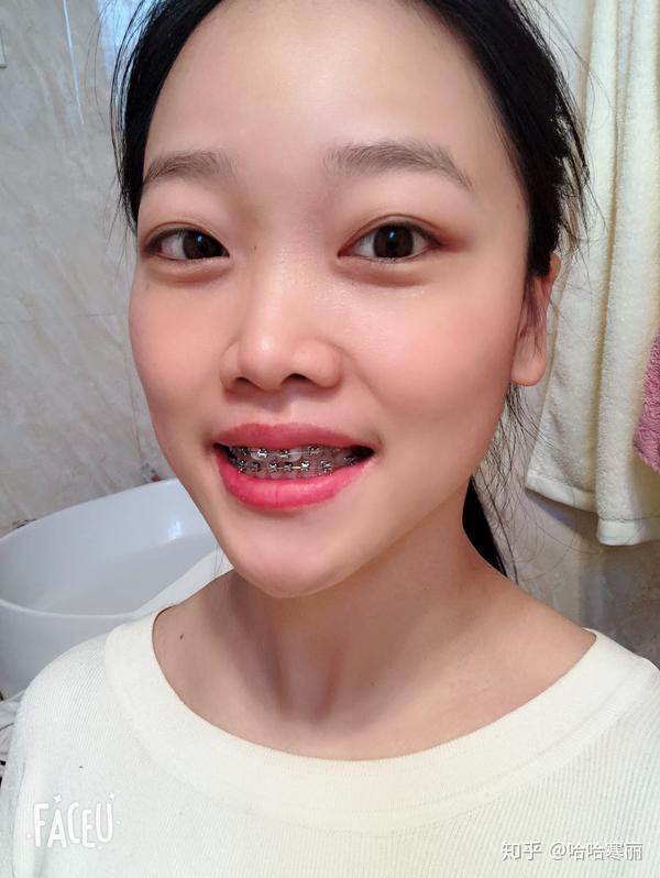 24岁带上牙套的日子