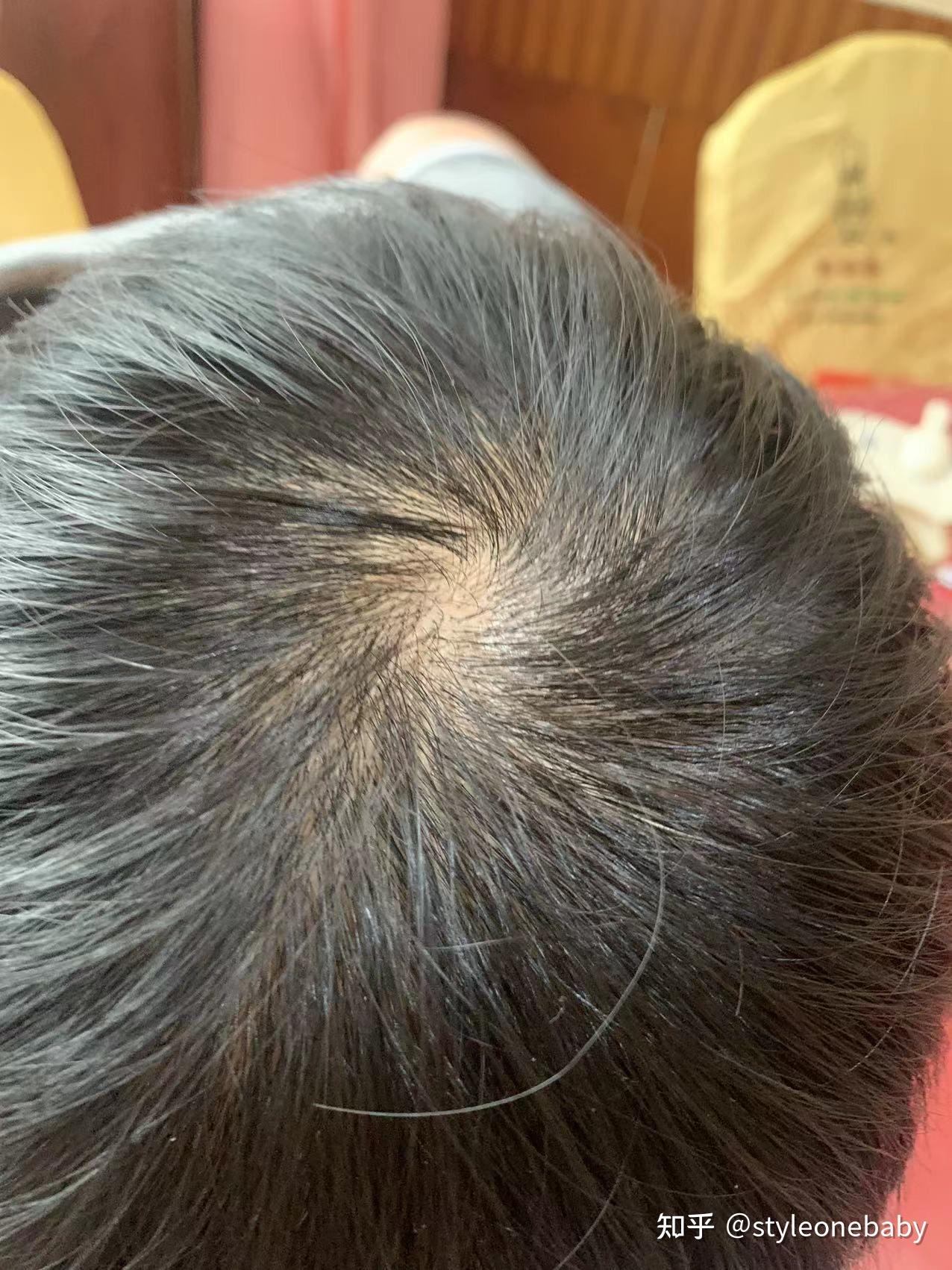 秃发男孩使用米诺地尔半个月来打卡! - 知乎