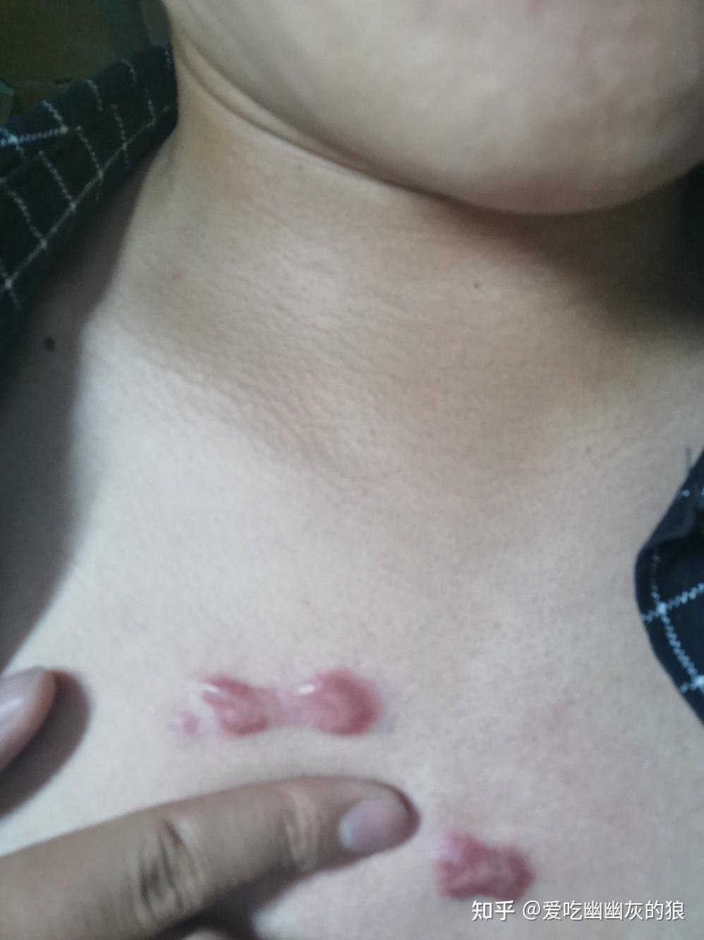 分享记录瘢痕疙瘩治疗路程