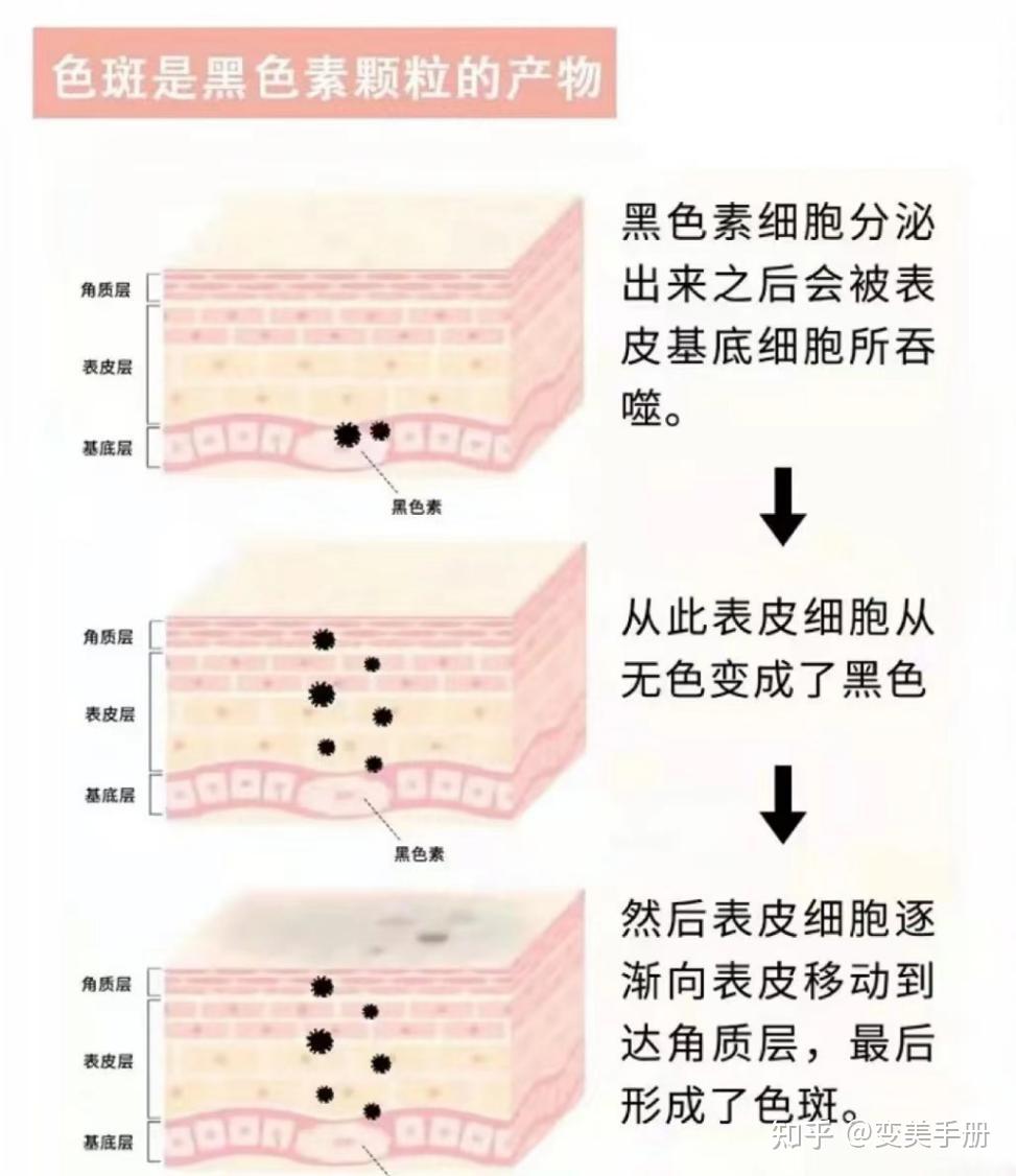 斑点是如何形成的呢?长斑的原因有哪些?